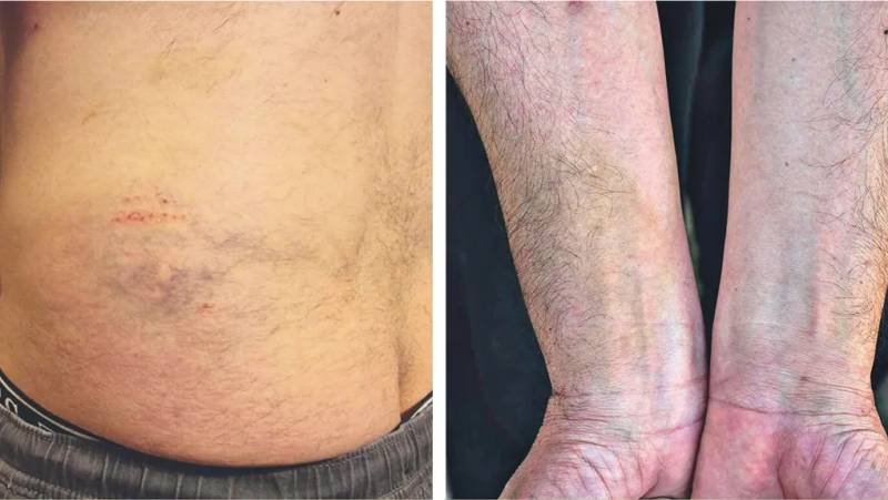 Επίδειξη δύναμης σε βάρος διαβητικού